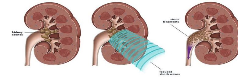 Kidney Stones Treatment in Delhi